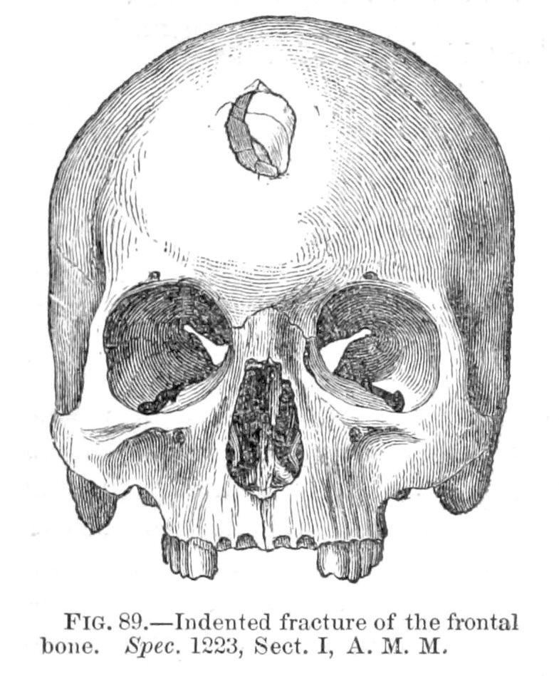 Calvaria trephined in the left frontal region (1862)